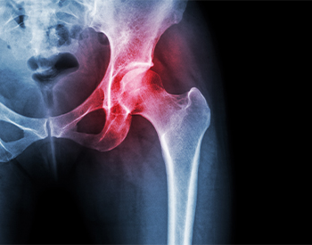 Hip Pain Relief Vienna, VA