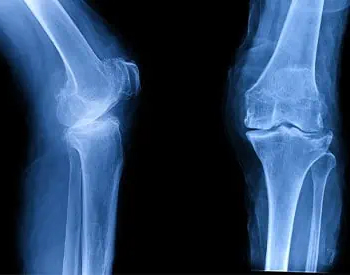 Osteoarthritis Treatment McLean