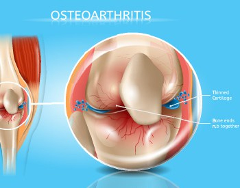 Osteoarthritis Treatment Vienna, VA