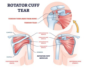 Shoulder Pain Treatment