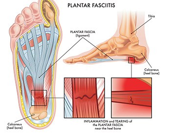 Foot Pain Treatment McLean