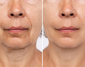 Facial Micro Needling McLean