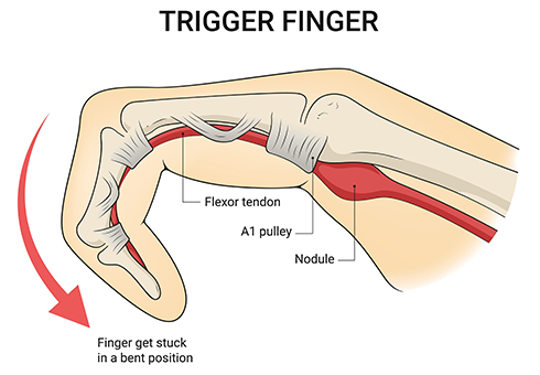 Trigger Finger Treatment Vienna