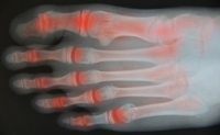 Chiropractic Care Can Help Arthritis
